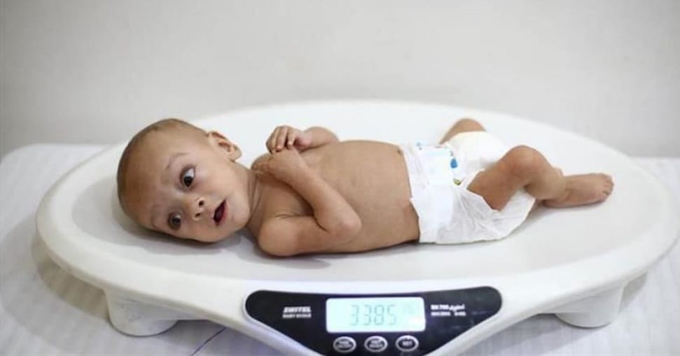 Satu dari Lima  Balita di Ngawi  Mengalami Stunting